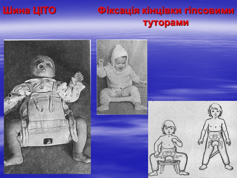 Шина ЦІТО  Фіксація кінцівки гіпсовими     туторами